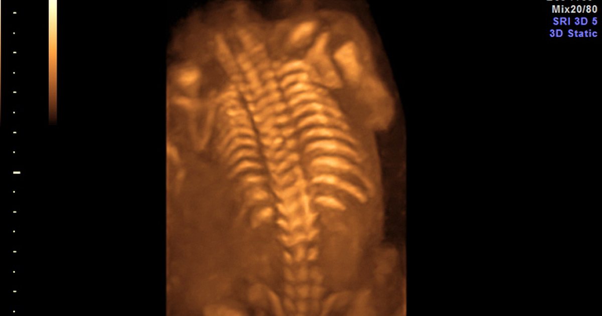 Ecografía en 3D de la columna de un feto de 21 semanas, imagen de referencia